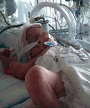 Development of a Continuous Positive Airway Pressure(CPAP) Device